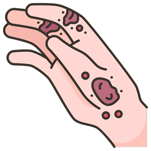 Atopic Dermatitis